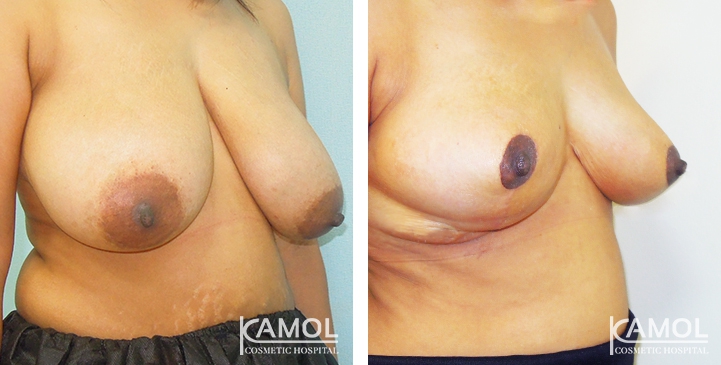 Before and After surgery 1 month Breast Reduction by inverted T-scarn