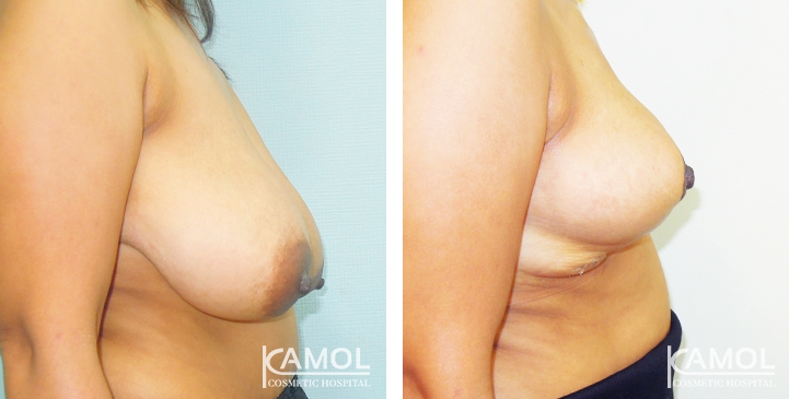 Before and After surgery 1 month Breast Reduction by inverted T-scar