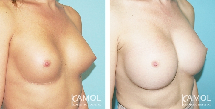 Before and After Capsular Contracture revision with new implant