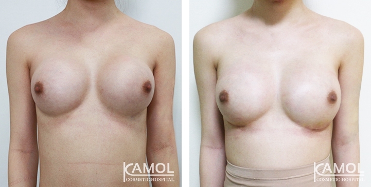 Before and After breast implant revision by upward correction