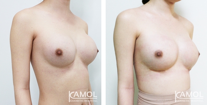 Before and After breast implant revision by upward correction