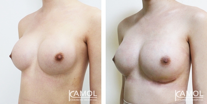 Before and After breast implant revision by upward correction