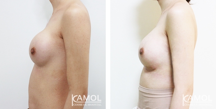 Before and After breast implant revision by upward correction