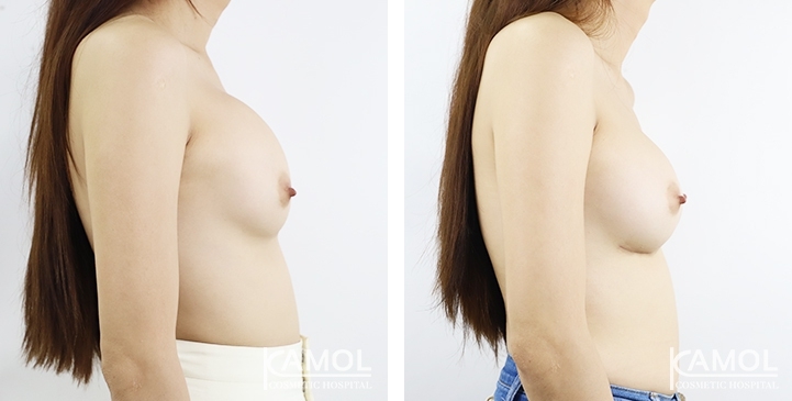 Before and After breast implant revision by upward correction