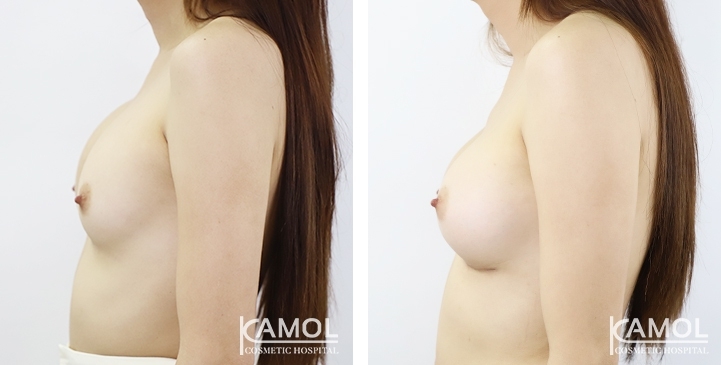 Before and After breast implant revision by upward correction