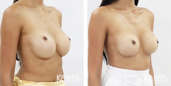 Before and After breast implant revision by Symmastia correction