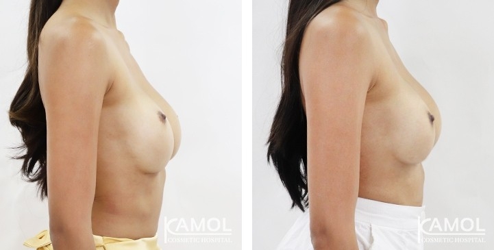 Before and After breast implant revision by Symmastia correction