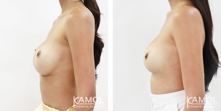 Before and After breast implant revision by Symmastia correction