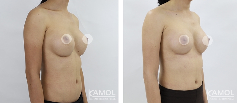 Before and After breast implant revision