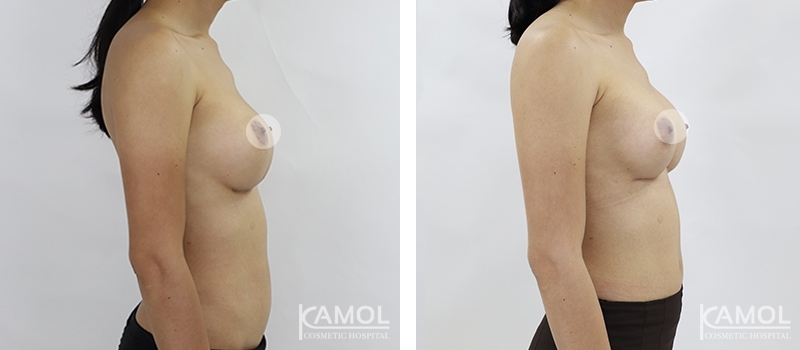 Before and After breast implant revision