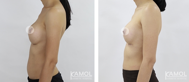 Before and After breast implant revision