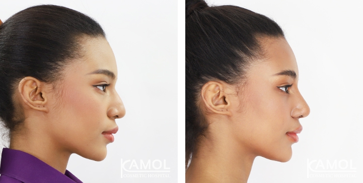 Before and After Rhinoplasty, Nose Job, Nose Surgery