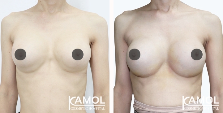 Before and After breast implant revision