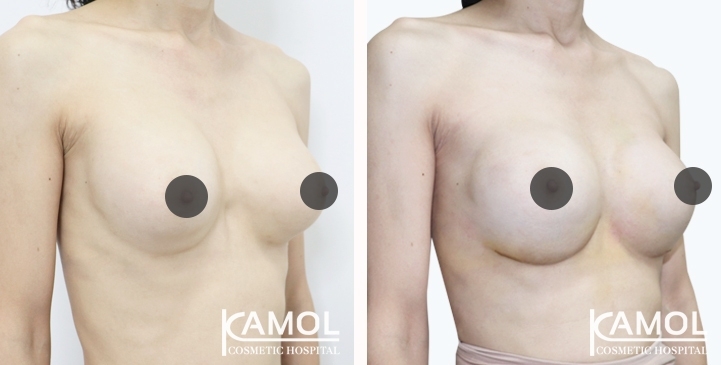 Before and After breast implant revision