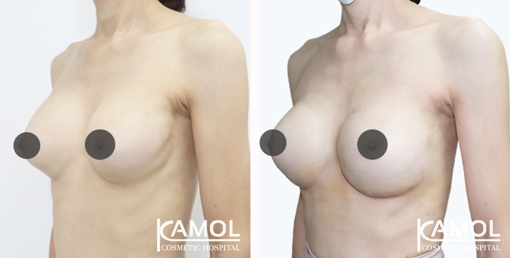 Before and After breast implant revision