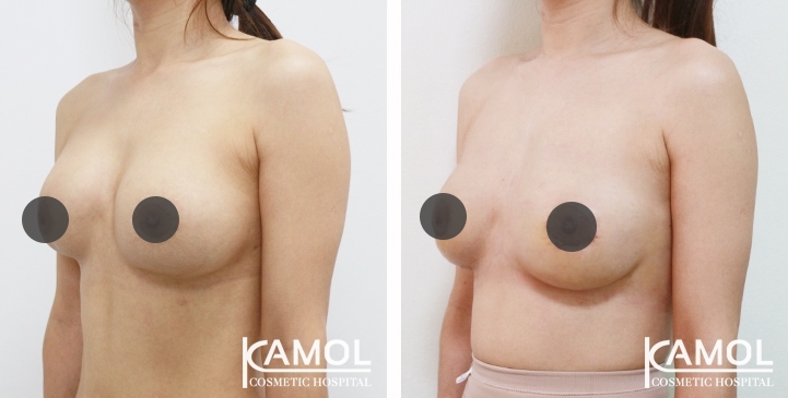 Before and After breast implant revision