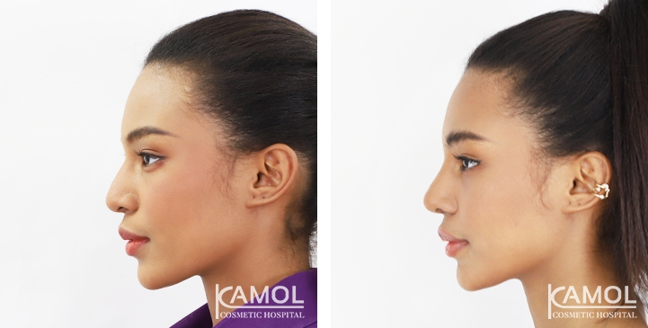 Before and After Rhinoplasty, Nose Job, Nose Surgery