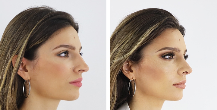 Before and After Rhinoplasty, Nose Job, Nose Surgery