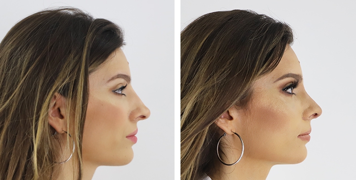 Before and After Rhinoplasty, Nose Job, Nose Surgery