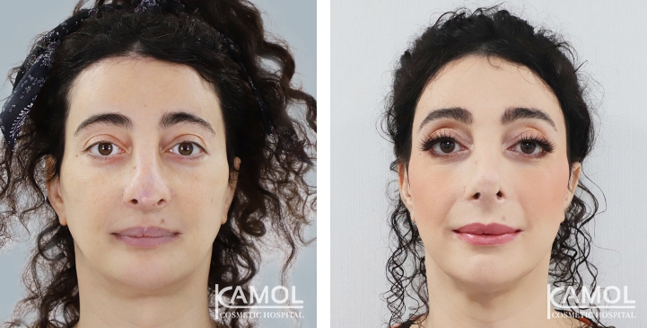 Before and After Rhinoplasty, Nose Job, Nose Surgery