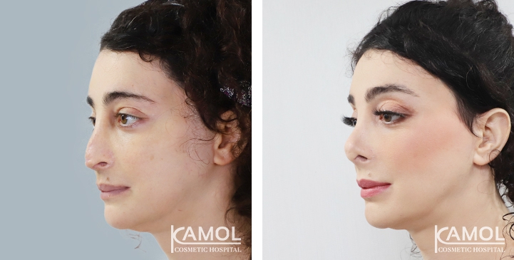 Before and After Rhinoplasty, Nose Job, Nose Surgery