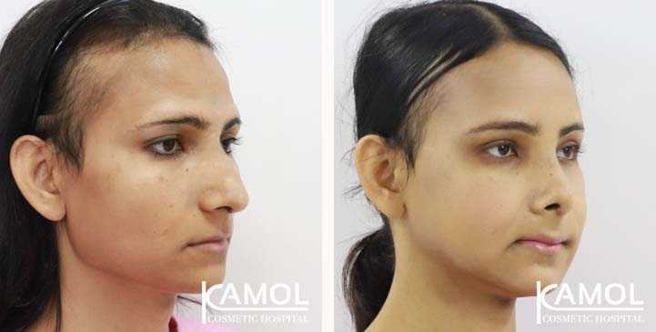 Facial Feminization Surgery