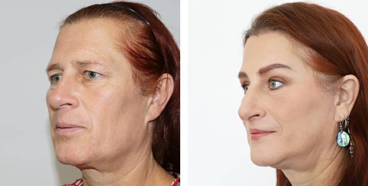 Before and After Augmentation Rhinoplasty, Nose Job, Nose Surgery