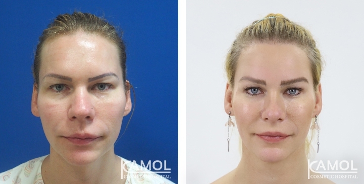 Before and After Rhinoplasty, Nose Job, Nose Surgery