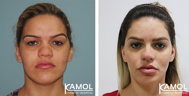 Before and After Rhinoplasty, Nose Job, Nose Surgery