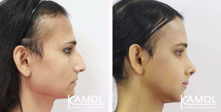 Facial Feminization Surgery