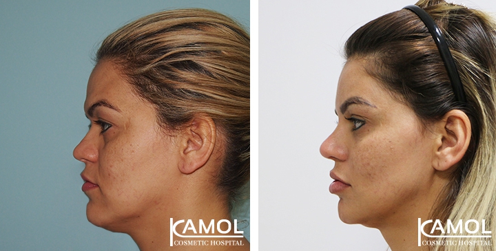 Before and After Rhinoplasty, Nose Job, Nose Surgery