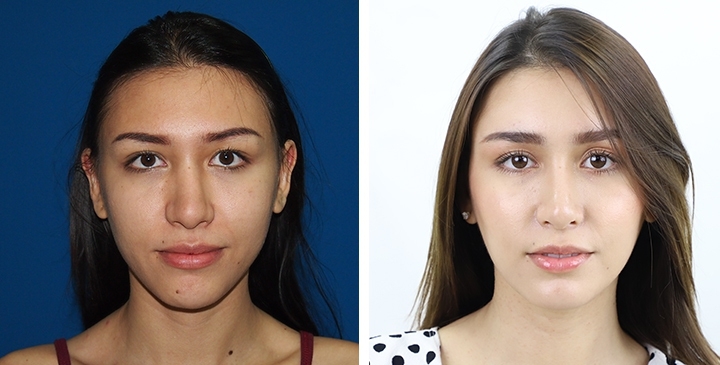 Before and After Rhinoplasty, Nose Job, Nose Surgery