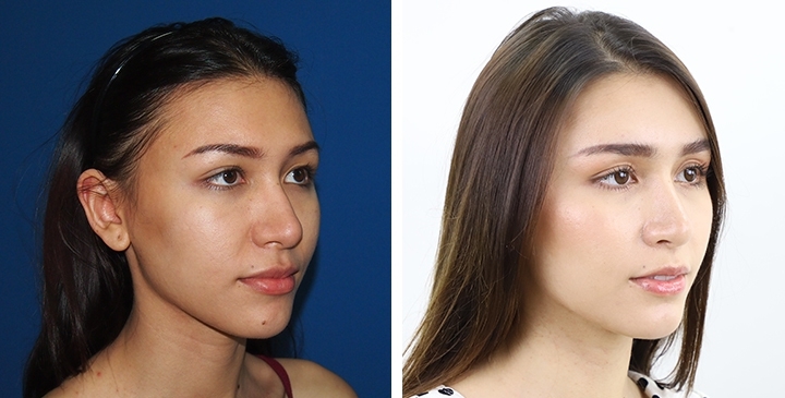 Before and After Rhinoplasty, Nose Job, Nose Surgery