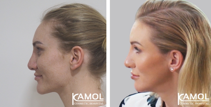 Before and After Rhinoplasty, Nose Job, Nose Surgery