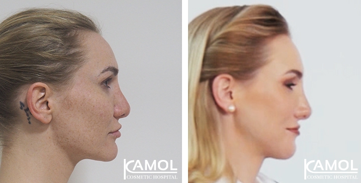 Before and After Rhinoplasty, Nose Job, Nose Surgery