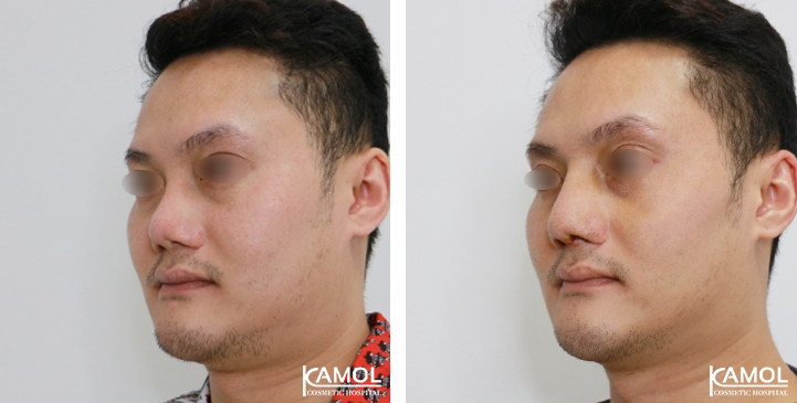 Before and After Revision Augmentation Rhinoplasy, Nose Job, Nose Surgery