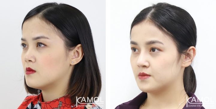 Before and After Augmentation Rhinoplasty, Nose Job, Nose Surgery