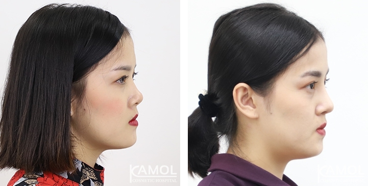 Before and After Augmentation Rhinoplasty, Nose Job, Nose Surgery