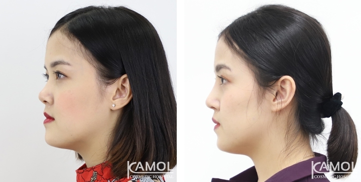 Before and After Augmentation Rhinoplasty, Nose Job, Nose Surgery