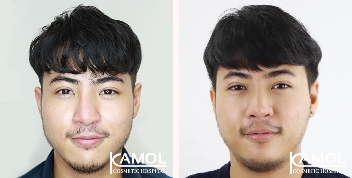 Before and After Augmentation Rhinoplasty, Nose Job, Nose Surgery