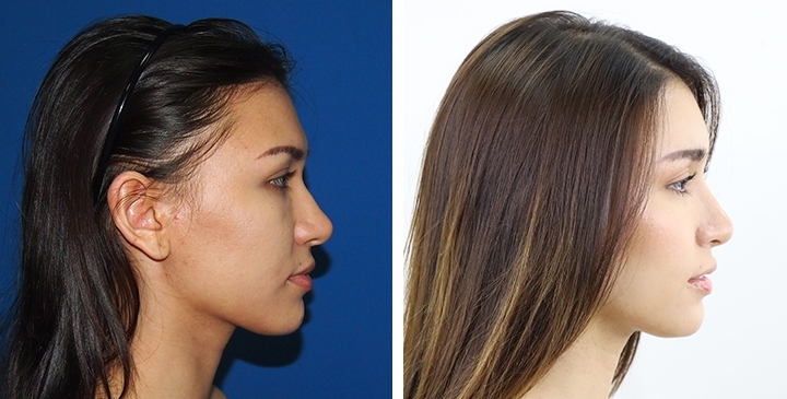 Before and After Augmentation Rhinoplasty, Nose Job, Nose Surgery