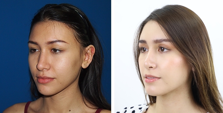 Before and After Augmentation Rhinoplasty, Nose Job, Nose Surgery