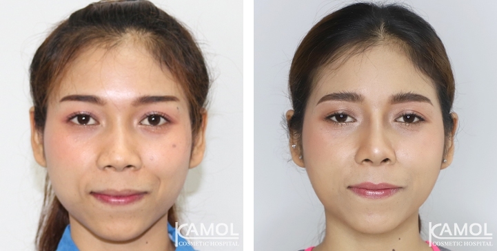 Before and After Augmentation Rhinoplasty, Nose Job, Nose Surgery