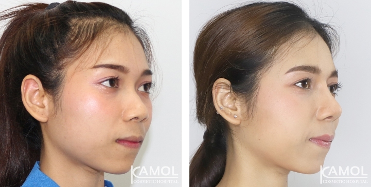 Before and After Augmentation Rhinoplasty, Nose Job, Nose Surgery