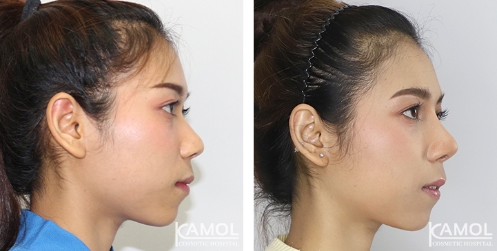 Before and After Augmentation Rhinoplasty, Nose Job, Nose Surgery