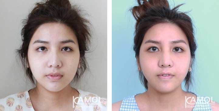 Before and After Augmentation Rhinoplasty, Nose Job, Nose Surgery