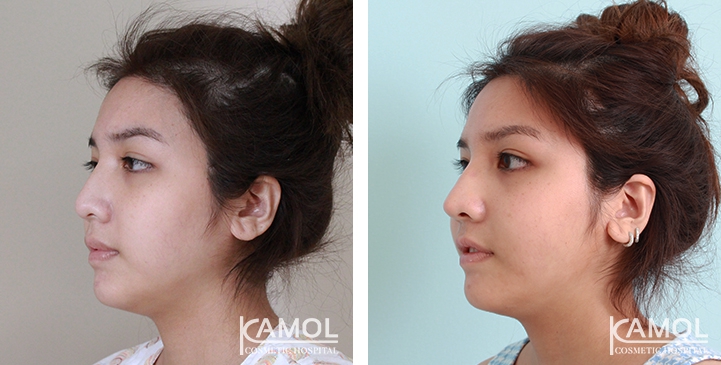 Before and After Augmentation Rhinoplasty, Nose Job, Nose Surgery