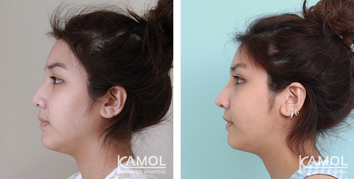 Before and After Augmentation Rhinoplasty, Nose Job, Nose Surgery