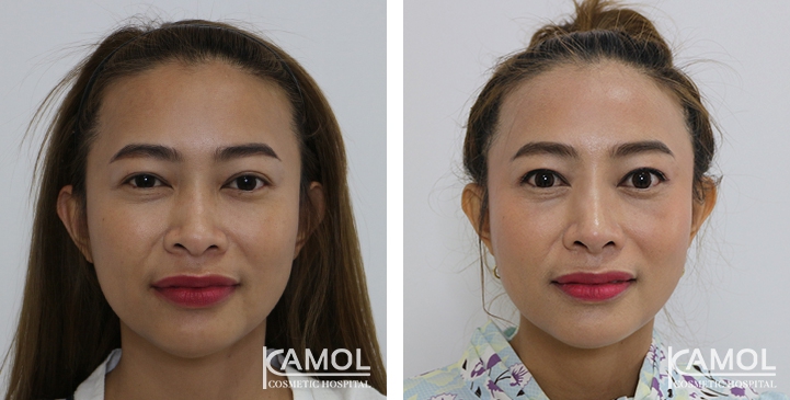 Before and After Augmentation Rhinoplasty, Nose Job, Nose Surgery