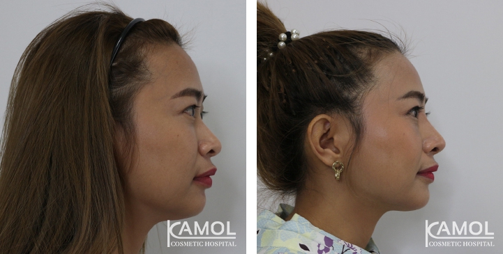 Before and After Augmentation Rhinoplasty, Nose Job, Nose Surgery